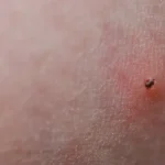 Hogyan kell a kullancsot eltávolítani?